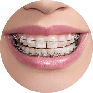 self-ligating-braces-img