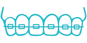 illustration of braces on teeth
